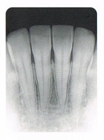 歯肉炎（初期の歯周病）