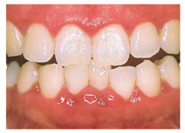 歯肉炎（初期の歯周病）